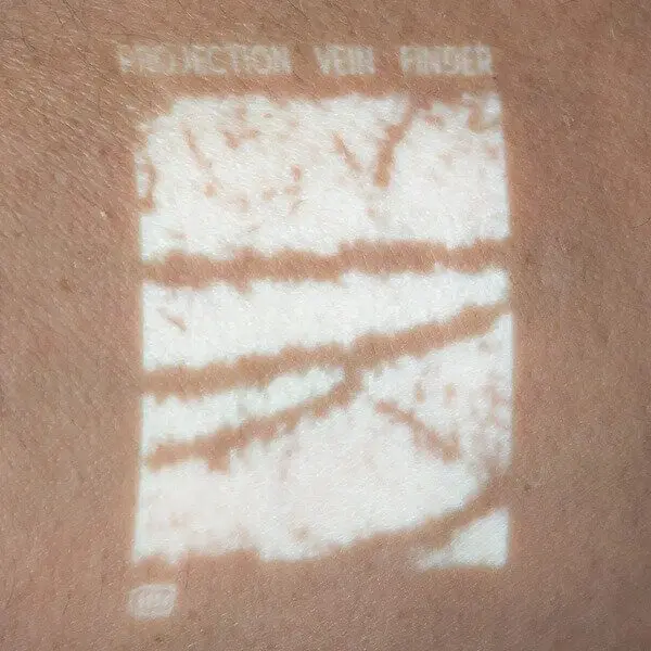 A closeup of the NextVein vein finder projection showing dark veins on a white background.