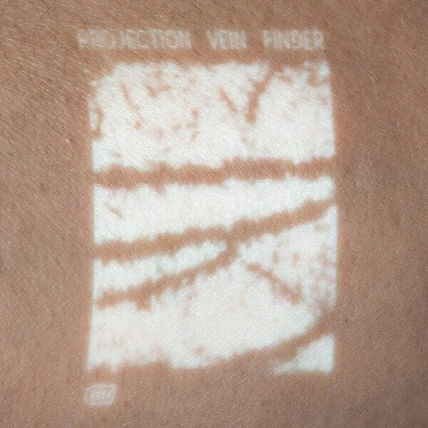 A closeup of the NextVein vein finder projection showing dark veins on a white background.