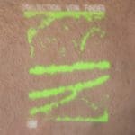 NextVein #39 s Vein Visualization Technology